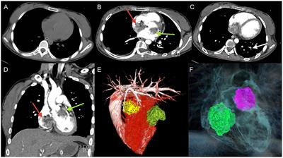 Case Report: Biatrial Myxoma With Pulmonary Embolism and Cerebral Embolism: Clinical Experience and Literature Review